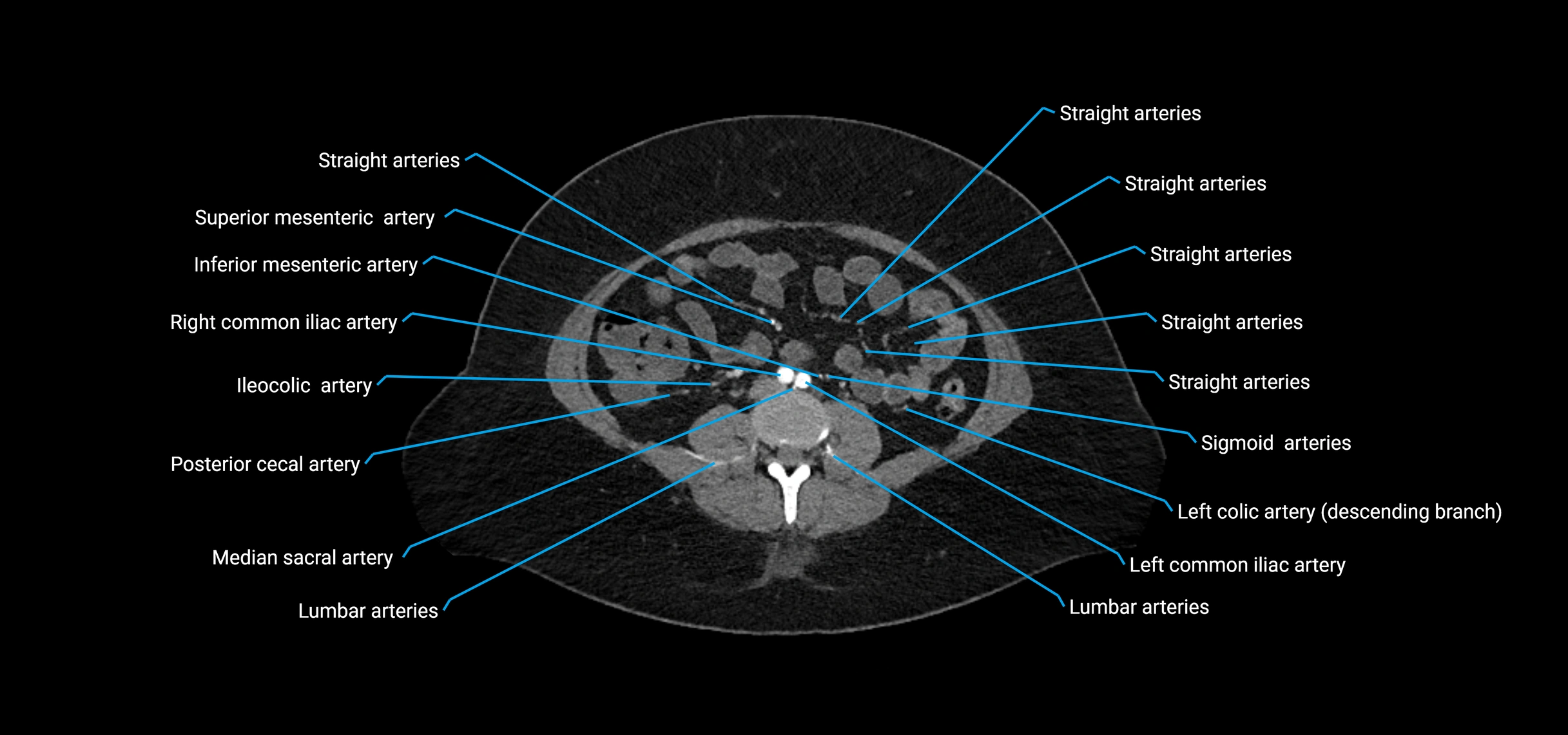 CTA abdomen axial cross sectional anatomy labelled image_126 (2).webp